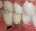 When the metal of an implant becomes visible a connective tissue graft is used to improve the mucosal height.