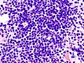 Bone marrow aspirate showing the histologic correlate of multiple myeloma under the microscope, H&E stain