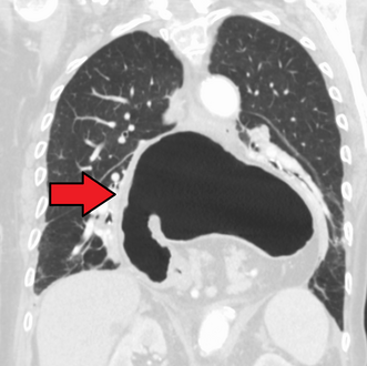 A large hiatal hernia as seen on CT imaging