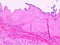 Histopathology of acute gangrenous cholecystitis, showing necrosis, neutrophils and partially sloughed off mucosa.