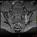 T1-weighted MRI with fat suppression after administration of gadolinium contrast showing sacroiliitis in a person with ankylosing spondylitis