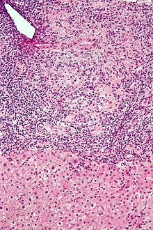 Intermediate-magnification micrograph of PBC showing bile duct inflammation and periductal granulomas, liver biopsy, H&E stain
