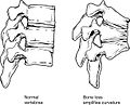 Collapse of vertebra on the right, normal on the left