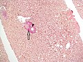 No fibrosis, but mild zone 3 steatosis, in which collagen fibres (pink–red, arrow) are confined to portal tracts (P) (Van Gieson's stain)[84]