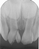 Längsfraktur im Kronenbereich eines mittleren oberen Milchschneidezahnes. Die bleibenden Zähne sind bereits zu erkennen.