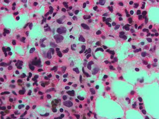 High magnification micrograph showing signet ring cells, with clear cytoplasm, in metastatic breast carcinoma. H&E stain.