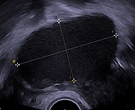 Transvaginal ultrasonography showing a 67 x 40 mm endometrioma, with a somewhat grainy content.