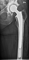 Hip prosthesis - anteroposterior view