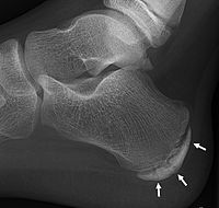 Sclerosis and fragmentation of the calcaneal apophysis
