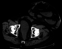 Computed tomography of same colostomy and parastomal hernia
