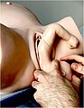 Step 4: Baby's hand appears under the maternal pubic symphysis, allowing the anterior arm to be delivered