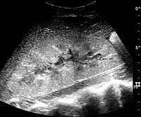 Renal ultrasonograph in renal failure after surgery with increased cortical echogenicity and kidney size. Biopsy showed acute tubular necrosis.[17]