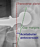Acetabular anteversion of a hip prosthesis