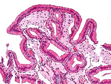 Micrograph of cholesterolosis of the gallbladder