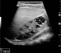 Figure 6. Complex cyst with thickened walls and membranes in the lower pole of an adult kidney. Measurements of kidney length and the complex cyst on the US image are illustrated by '+' and dashed lines.[1]