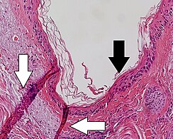 Folding artifacts (white arrows) and a crush artifact (black arrow, with cytoplasmic hypereosinophilia and nuclear pleomorphism) from a needle