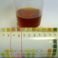 Dark red urine due to choluria.