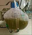 Green urine during long term infusion of the sedative propofol.