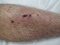 Petechia of the lower leg in a person with platelets of 3 due to ITP