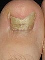 Image 7Onychomycosis (from Fungal infection)