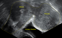Subserosal uterine fibroid