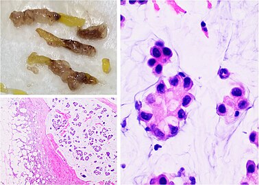 Mucinous carcinoma of the breast: Gross pathology (upper left) of mucinous carcinoma shows gelatinous areas. Histopathology shows clusters or nests of tumor cells floating in pools of extracellular mucin.[3]
