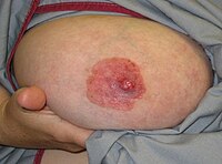 Paget's disease of the nipple[5]