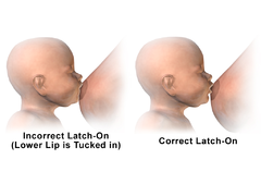 Breastfeeding - Incorrect vs correct latch-on.