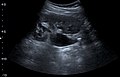 Renal ultrasonograph of a stone located at the pyeloureteric junction with accompanying hydronephrosis.