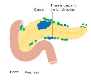 Pancreatic cancer in nearby lymph nodes – Stage N1