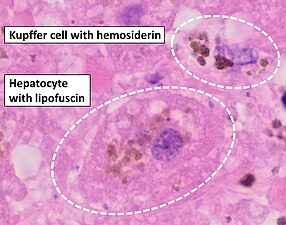 Histopathology of the liver, showing a Kupffer cells with significant hemosiderin deposition next to a hepatocyte with lipofuscin pigment. H&E stain.