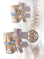 Illustration depicting herniated disc and spinal nerve compression