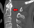 Type 2 dens fracture