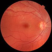 Fundus photograph of normal right eye