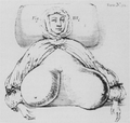 Illustration of gigantomastia