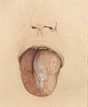Tongue (inflammatory)