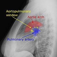 Aortopulmonary window