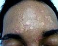 Image 3Pityriasis versicolor (from Fungal infection)