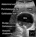 Gallstones and biliary sludge, but the gallbladder wall is not clearly thickened, with no edema in the pericholecystic fat, thus not cholecystitis.