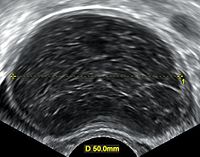 Transvaginal ultrasonography of a hemorrhagic ovarian cyst, probably originating from a corpus luteum cyst. The coagulating blood gives the content a cobweb-like appearance.