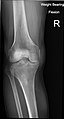 Knee X-ray (weight bearing, flexion)