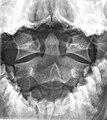 Axis on X-ray taken through an open mouth, teeth visible