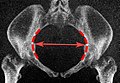 Low-dose CT scan of the transverse diameter of the pelvic inlet, as part of pelvimetry