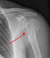 Fracture of the proximal humerus
