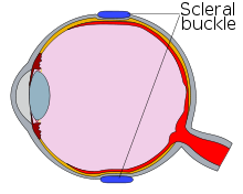 Cross-section diagram of an eye, now showing scleral buckle, in blue, pressing in on the top and bottom of the eye, pressing the choroid lens and the retina together.
