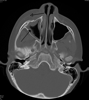 Maxillary sinusitis caused by a dental infection associated with periorbital cellulitis