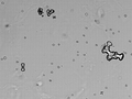 Urine microscopy showing several calcium oxalate monohydrate crystals (dumbbell shaped, some of them clumped) and a calcium oxalate dihydrate crystal (envelope shaped) along with several erythrocytes.