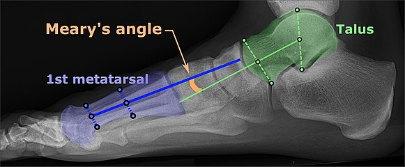 Same lateral X-ray showing the measurement of Meary's angle, which is the angle between the long axis of the talus and first metatarsal bone.[11] An angle greater than 4° convex downward is considered a flat foot, 15° - 30° moderate flat foot, and greater than 30° severe flat foot.[11]