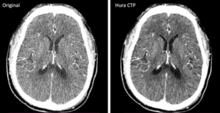 Original (left side) compared to reconstructed (right side) brain image produced from CT scans with low radiation dose. Reconstruction method improves image quality for accurate diagnosis. Image credit: Danny JJ Wang, Hura Imaging, INC, Los Angeles.