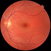 Fundus photograph of normal left eye